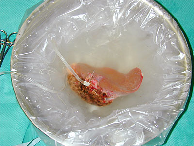 図14　ドナーから摘出後冷却保存される移植用肝臓