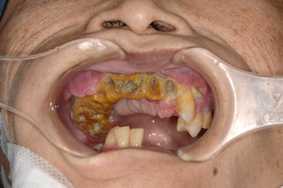 下顎骨に生じたARONJ患者の口腔内写真1