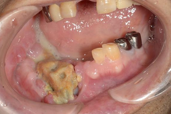 下顎骨に生じたARONJ患者の口腔内写真2
